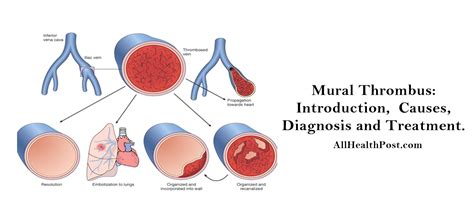 mural thrombus vs intramural